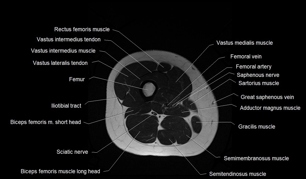 MRI thigh cross sectional anatomy image 39.webp
